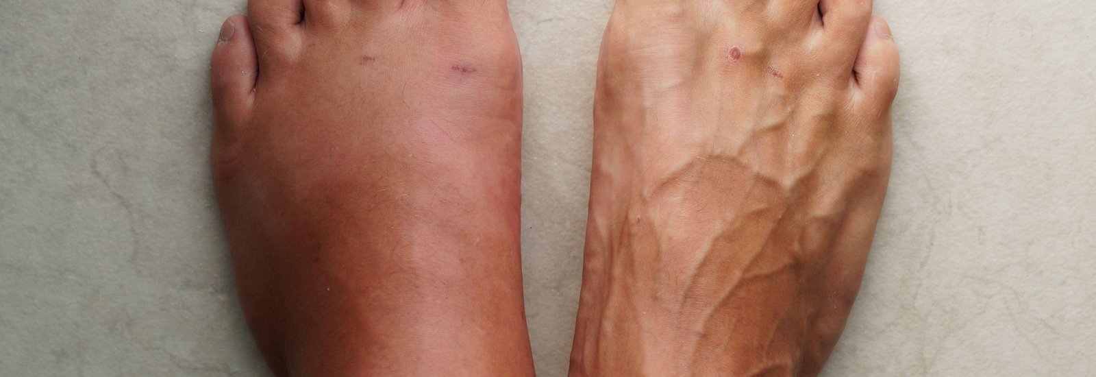 Injured foot